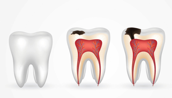 Dental Caries Progression